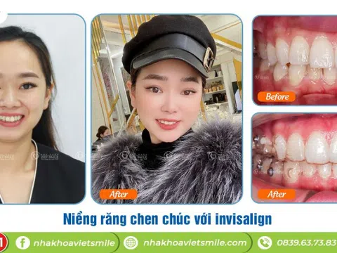 Niềng răng invisalign chỉ điều trị ca đơn giản? Hiểu đúng để chọn đúng