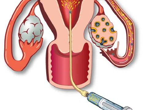 Bơm IUI và điều bạn cần biết