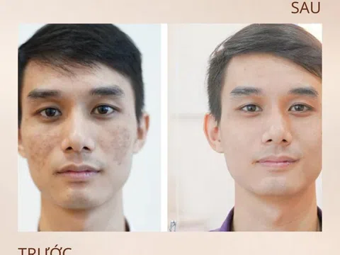 Liệu trình trị nám, tàn nhan hiệu quả dành cho nam tại Spa Men&Man