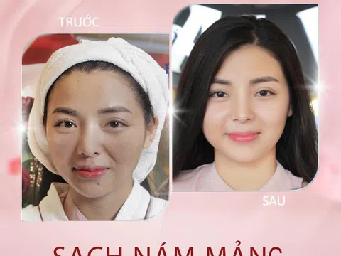 Thẩm mỹ viện BENA - USA tại Cà Mau: Hỗ trợ điều trị nám, tàn nhang an toàn và hiệu quả