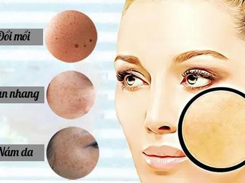 Bộ đôi trong uống ngoài bôi Babolica - Giúp làm mờ nám da, tàn nhang, đồi mồi