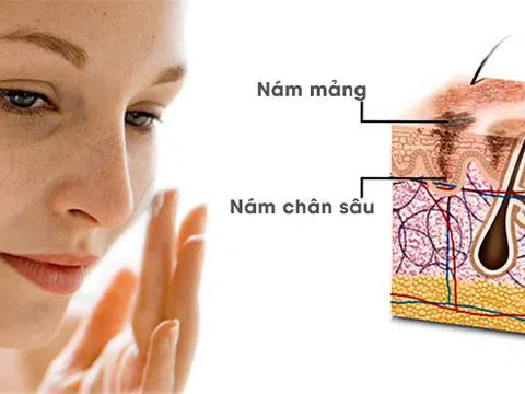 DỊCH VỤ TRỊ NÁM LASER PICOSURE Tại TMV Quốc Tế Bắc Âu
