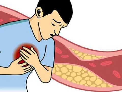 Kyoman – viên uống thảo dược hạ mỡ máu, ngừa nguy cơ bệnh tim mạch