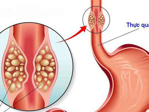 Trung Quốc phát triển mô hình chẩn đoán ung thư thực quản có độ chính xác cao