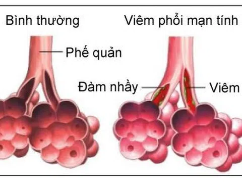 Bộ Y tế khuyến cáo về phòng chống viêm phổi cấp do chủng vi rút mới tại Trung Quốc