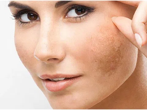 Giải mã bí mật của viên uống mờ nám đang được chị em…