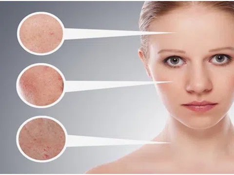 Giải mã những điều chị em chưa biết về nám, sạm da