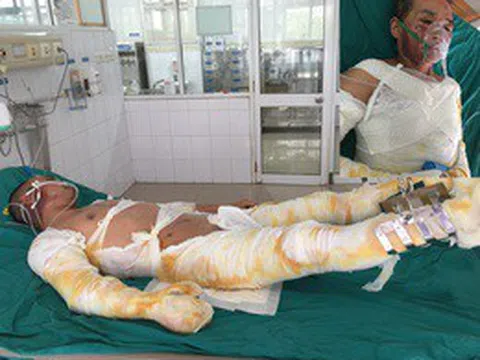 Ba người trong gia đình bị lửa thiêu nguy kịch cầu mong nhà hảo tâm giúp đỡ